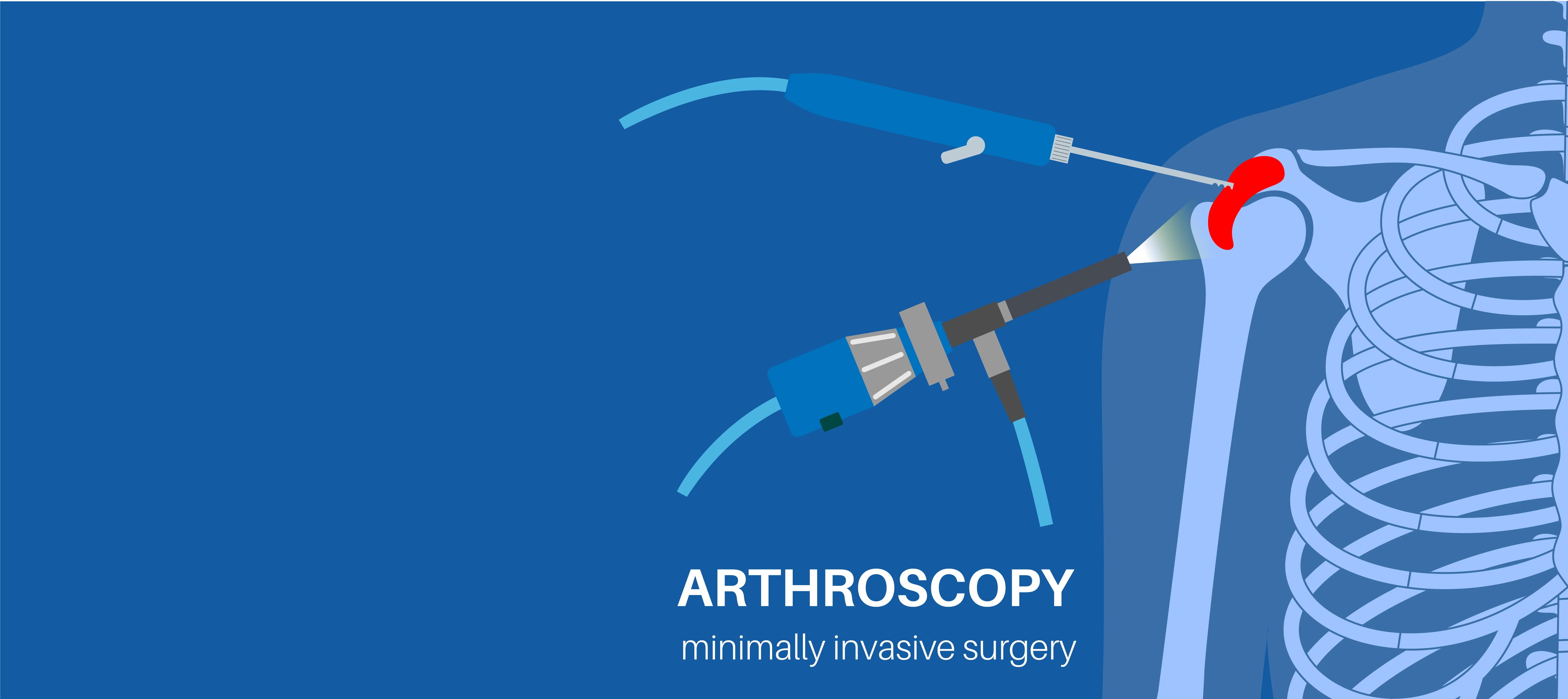 Everything You Should Know About Shoulder Arthroscopy